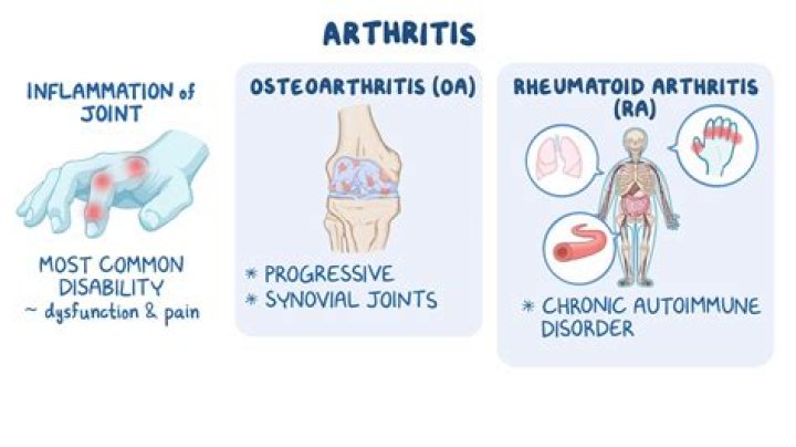 Can you get rheumatoid arthritis in your 30s?