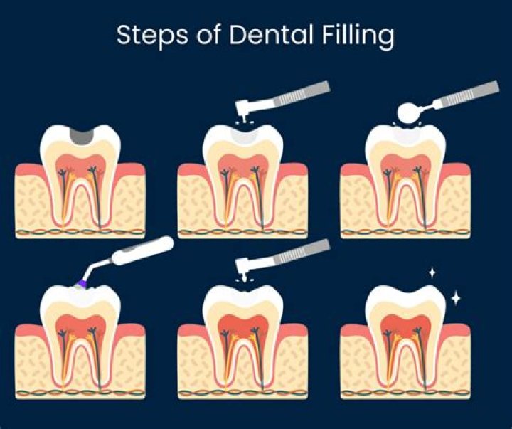 How long does it take for a tooth to settle after a filling?