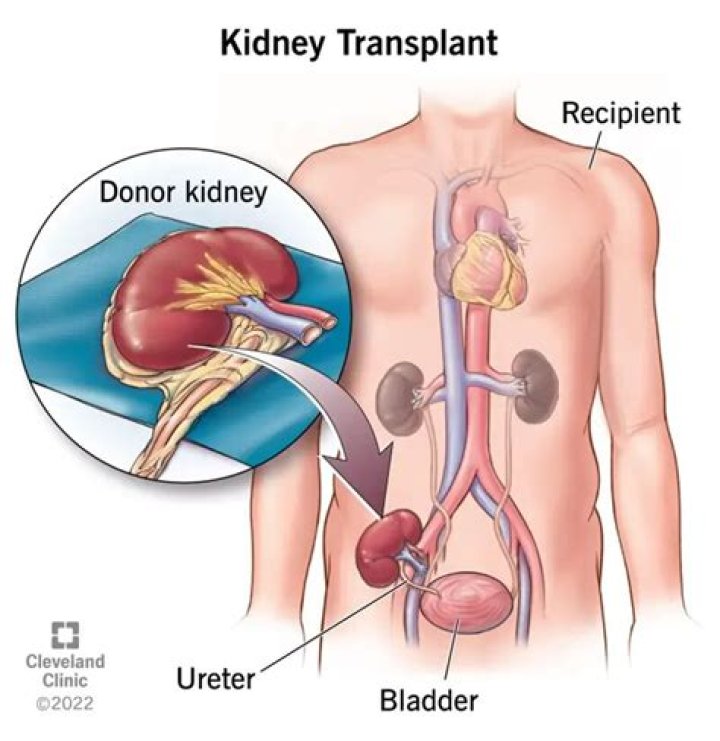 How many years does a kidney transplant last?