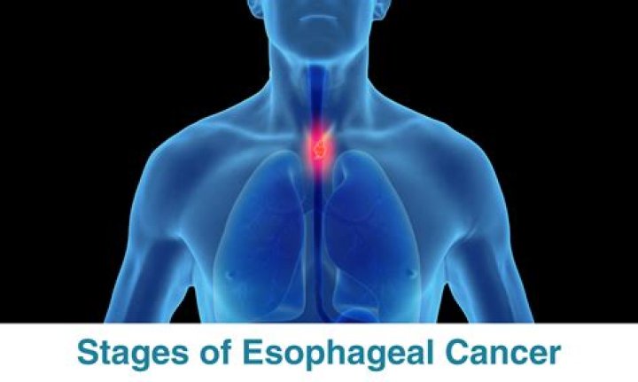 Is esophageal cancer curable at Stage 3?