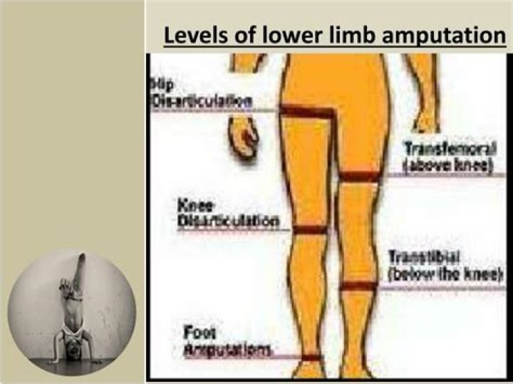 What is the most common lower limb amputation?