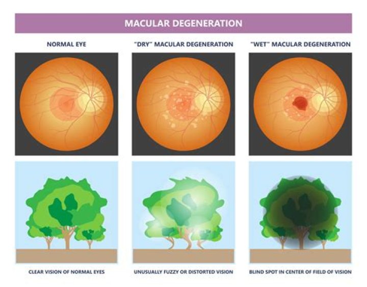 What should you do if you suspect macular degeneration?