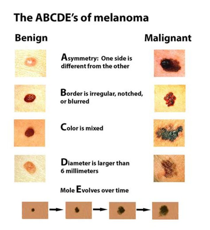 Why is melanoma so deadly?